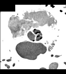 Diseased Aortic Valve - CTisus CT Scan