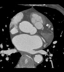 Left Anterior Descending Coronary Artery (LAD) Stent in Patient - CTisus CT Scan