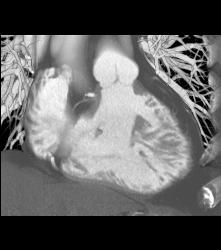 Left Anterior Descending Coronary Artery (LAD) Stent in Patient - CTisus CT Scan