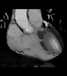 Left Anterior Descending Coronary Artery (LAD) Stent in Patient - CTisus CT Scan