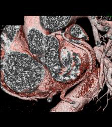 Left Anterior Descending Coronary Artery (LAD) Stent in Patient - CTisus CT Scan