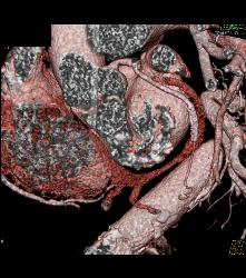 Left Anterior Descending Coronary Artery (LAD) Stent in Patient - CTisus CT Scan