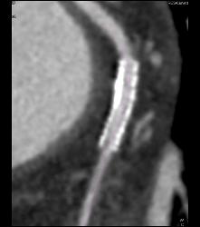 Left Anterior Descending Coronary Artery (LAD) Stent in Patient - CTisus CT Scan