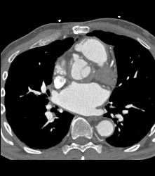 Repair of Aortic Root - CTisus CT Scan