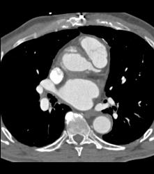 Repair of Aortic Root - CTisus CT Scan