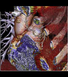 Left Internal Mammary Artery (LIMA) Graft - CTisus CT Scan