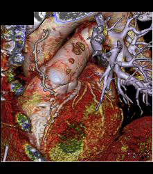 Left Internal Mammary Artery (LIMA) Graft - CTisus CT Scan