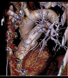 Left Internal Mammary Artery (LIMA) Graft - CTisus CT Scan