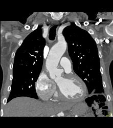 Left Internal Mammary Artery (LIMA) Graft - CTisus CT Scan