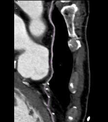 Left Internal Mammary Artery (LIMA) Graft - CTisus CT Scan