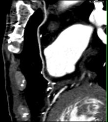 Left Internal Mammary Artery (LIMA) Graft - CTisus CT Scan