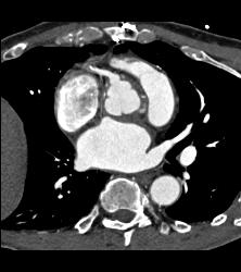 Left Internal Mammary Artery (LIMA) Graft - CTisus CT Scan