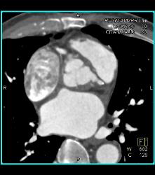 Dilated RCA At Reimplantation Site - CTisus CT Scan