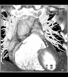 Dilated RCA At Reimplantation Site - CTisus CT Scan