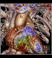 Dilated RCA At Reimplantation Site - CTisus CT Scan