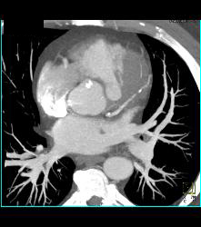 Bicuspid Valve With Diseased Valve - CTisus CT Scan