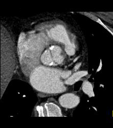 Bicuspid Valve With Diseased Valve - CTisus CT Scan