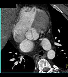 Bicuspid Valve With Diseased Valve - CTisus CT Scan