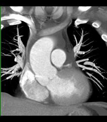 Bicuspid Valve With Diseased Valve - CTisus CT Scan