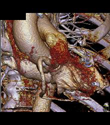 RCA Disease With Dilated RCA - CTisus CT Scan