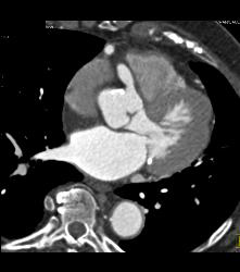 RCA Disease With Dilated RCA - CTisus CT Scan