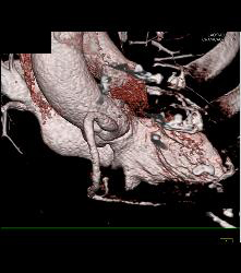 RCA Disease With Dilated RCA - CTisus CT Scan