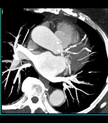 Diseased Left Anterior Descending Coronary Artery (LAD) and Circumflex - CTisus CT Scan