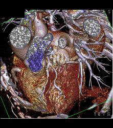 Diseased Left Anterior Descending Coronary Artery (LAD) and Circumflex - CTisus CT Scan