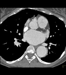 Dilated RCA At Reimplantation Site - CTisus CT Scan