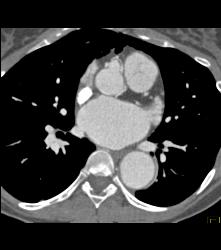 Dilated RCA At Reimplantation Site - CTisus CT Scan