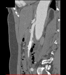 Stent in SMA - CTisus CT Scan