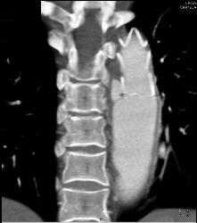 Stent in SMA - CTisus CT Scan