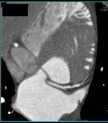 Plaque in Right Coronary Artery (RCA) - CTisus CT Scan