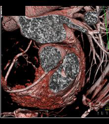 Plaque in Right Coronary Artery (RCA) - CTisus CT Scan