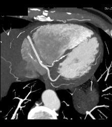 Plaque in Right Coronary Artery (RCA) - CTisus CT Scan