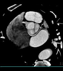 Anomalous Origin of Left Anterior Descending Coronary Artery (LAD) Off Right Cusp - CTisus CT Scan