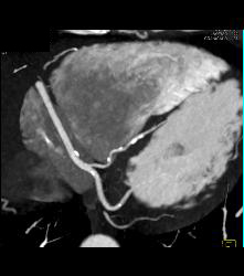 Anomalous Origin of Left Anterior Descending Coronary Artery (LAD) Off Right Cusp - CTisus CT Scan