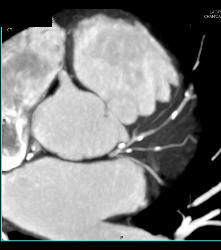 Left Anterior Descending Coronary Artery (LAD) Disease - CTisus CT Scan