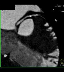 Left Anterior Descending Coronary Artery (LAD) Disease - CTisus CT Scan