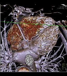 Left Anterior Descending Coronary Artery (LAD) Disease - CTisus CT Scan