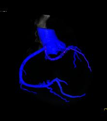 Left Anterior Descending Coronary Artery (LAD) Disease - CTisus CT Scan