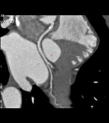 Left Anterior Descending Coronary Artery (LAD) Disease - CTisus CT Scan