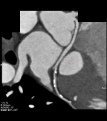 Left Anterior Descending Coronary Artery (LAD) Disease - CTisus CT Scan