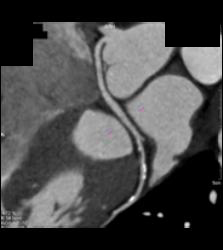 Left Anterior Descending Coronary Artery (LAD) Disease - CTisus CT Scan