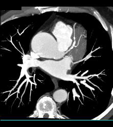 Left Anterior Descending Coronary Artery (LAD) Disease - CTisus CT Scan