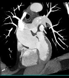 Left Anterior Descending Coronary Artery (LAD) Disease - CTisus CT Scan