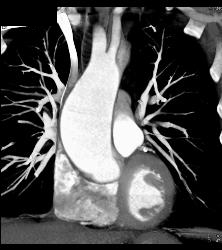 Dilated Aortic Root - CTisus CT Scan