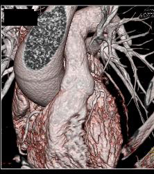 Dilated Aortic Root - CTisus CT Scan