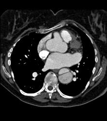 Dilated Sinuses of Valsalva in A Marfan Patient - CTisus CT Scan