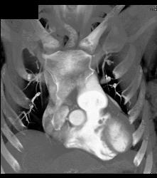 Dilated Sinuses of Valsalva in A Marfan Patient - CTisus CT Scan